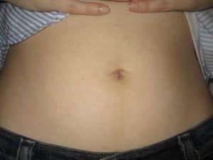 Gastric Sleeve Scars and Incisions: Scarless Alternatives Available