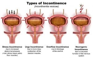 Types of Incontinence: Stress, Urge, Overactive, & Retention