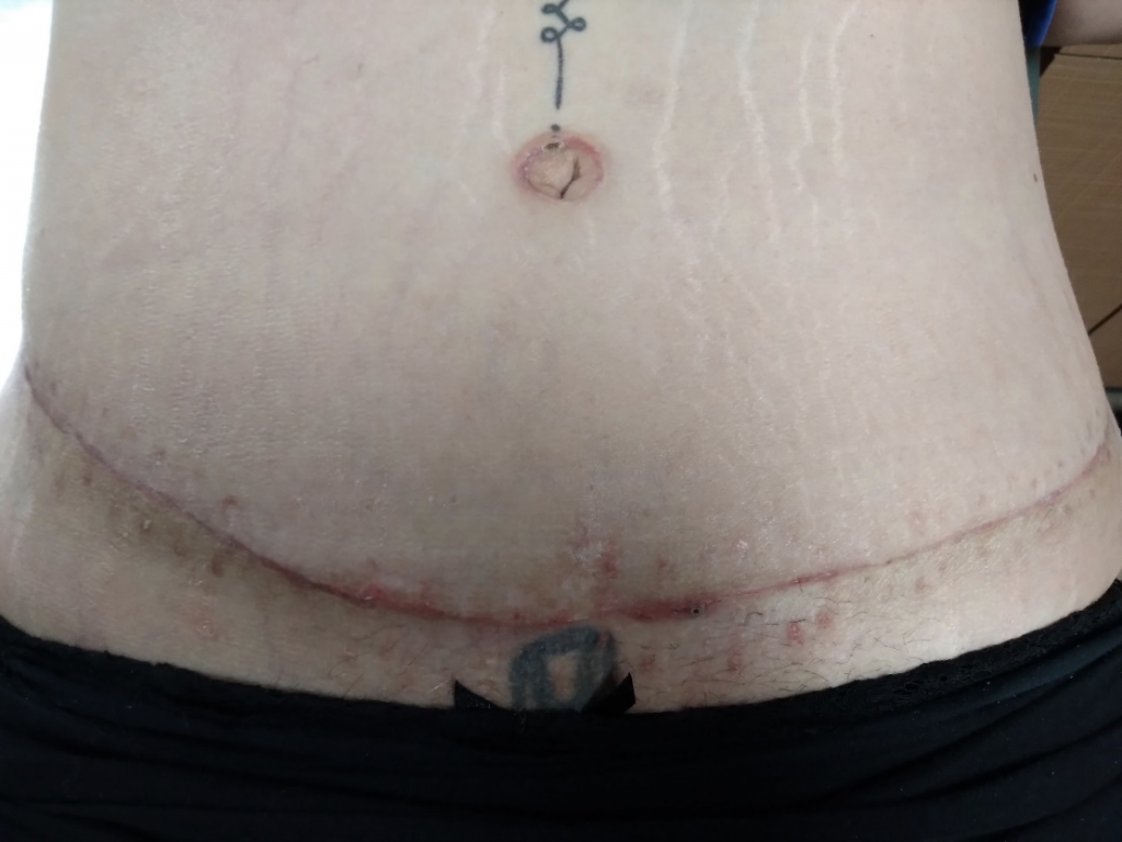 excess-skin-after-weight-loss-surgery