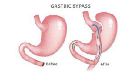 gastric-bypass-nevada-surgical