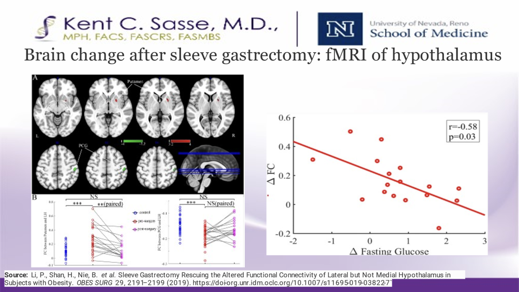 nevada-surgical-brain-change-after-sleeve-gastrectomy