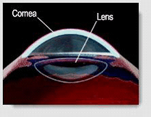 LASIK Eye surgery