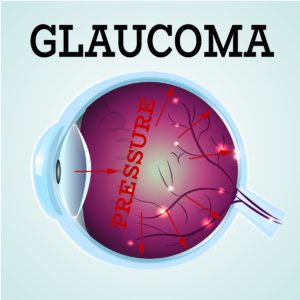 Glaucoma detection Scottsdale & Glendale