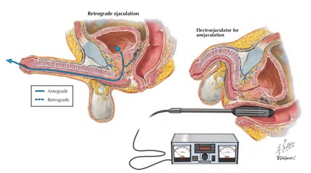 Retrograde Ejaculation