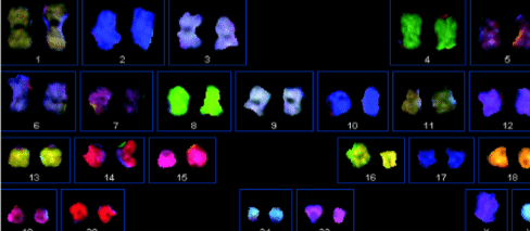 Nonobstructive azoospermia Beverly Hills 