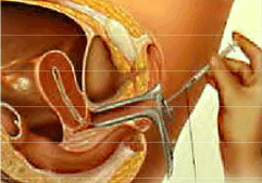 Intrauterine Insemination (IUI) Process