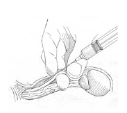 No-Scalpel Vasectomy Process