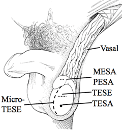 Surgical Sperm Retrieval Beverly Hills