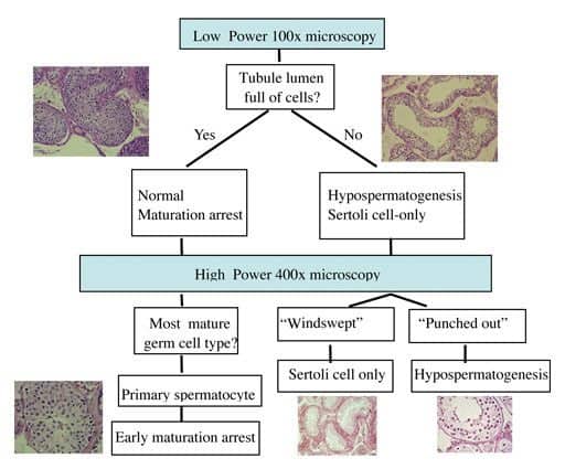 No Sperm Found in Testicular Biopsy