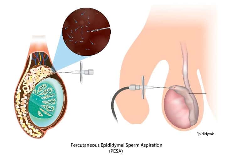 Sperm Retrieval Method Illustration