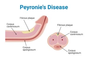 Diagram showing penis affected by Peyronie’s Disease