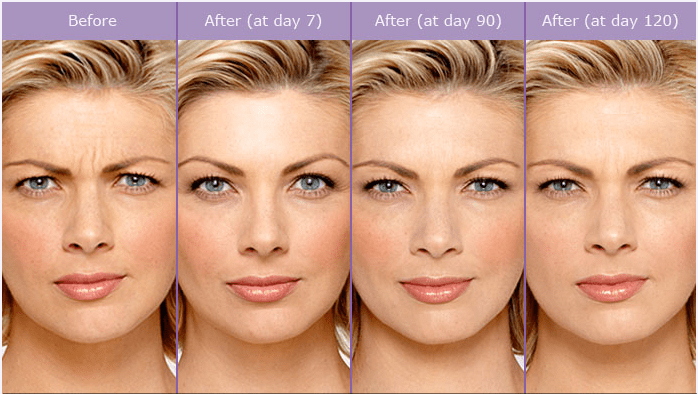 botox injections la jolla