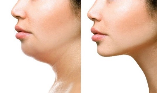 neck liposuction san diego