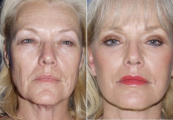 Facelift Before & After Photos: What a Facelift Looks Like at 40, 50, 60 &  70, Facelift in San Diego, CA