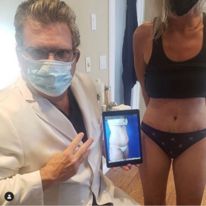 Rapid Recovery Tummy Tuck San Diego