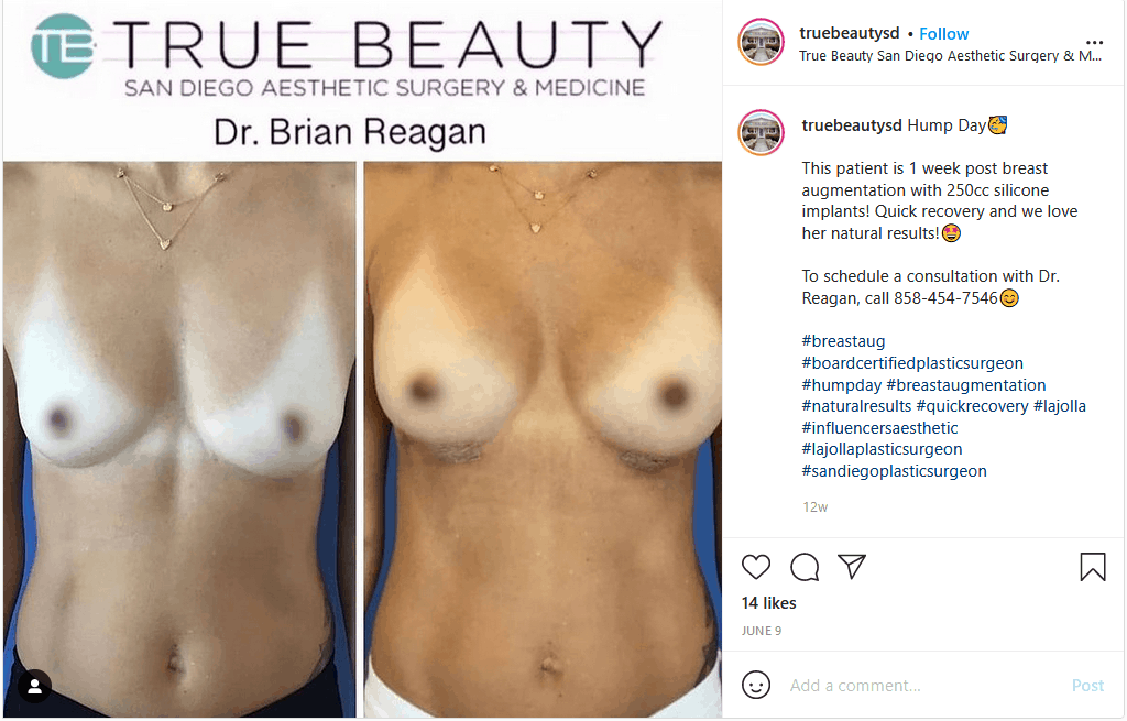 Breast Augmentation Blog from San Diego Plastic Surgeon