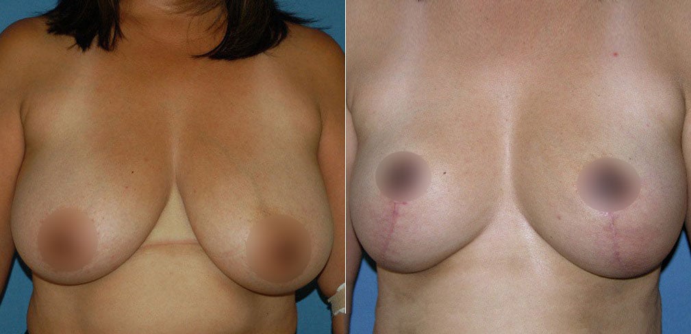 Breast Reduction Procedure Before & After San Diego & La Jolla CA