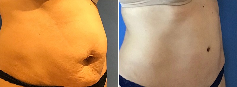 Tummy Tuck Patient Results