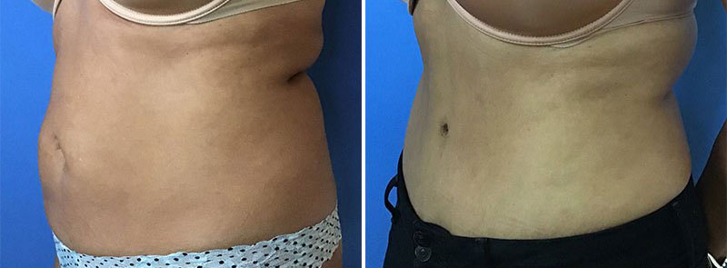 Liposuction Surgery Before & After San Diego & La Jolla CA
