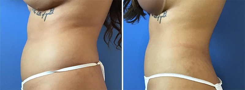 Liposuction Before & After in San Diego & La Jolla CA