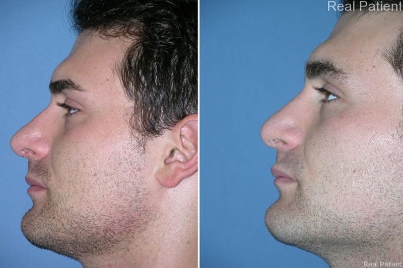 Male Rhinoplasty Patient