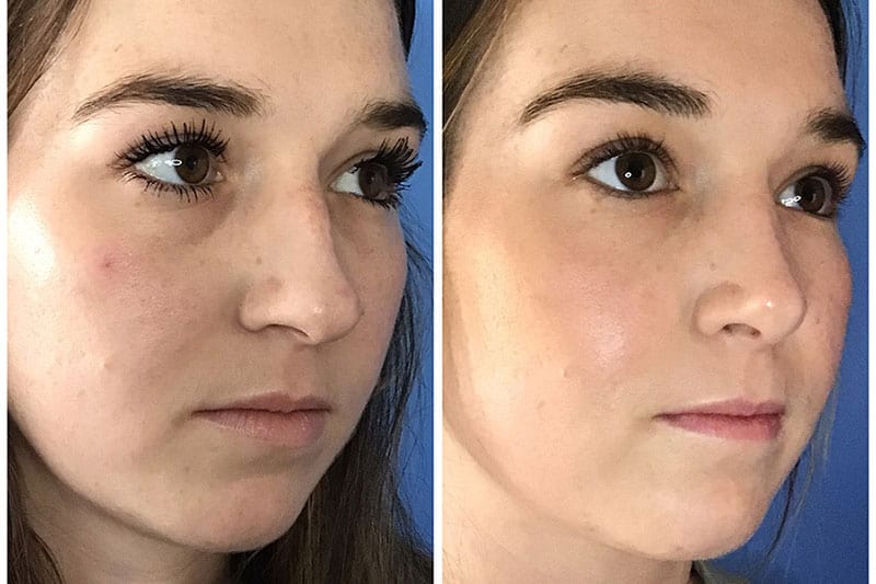 Nose Surgery Patient Before After Photos