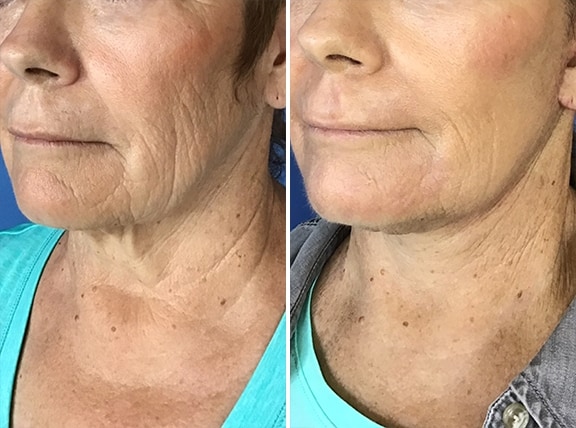 Facelift Before and After Photo