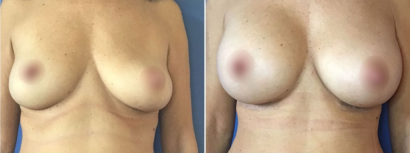 Breast Implant Before and After Photos