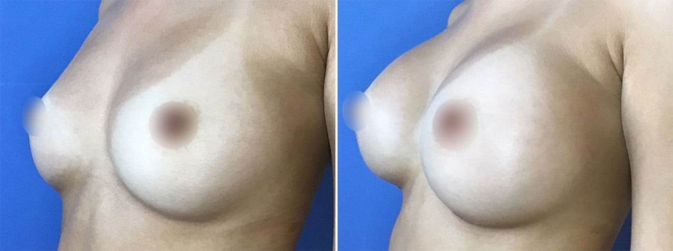 Breast Implant Surgery Patient Photos