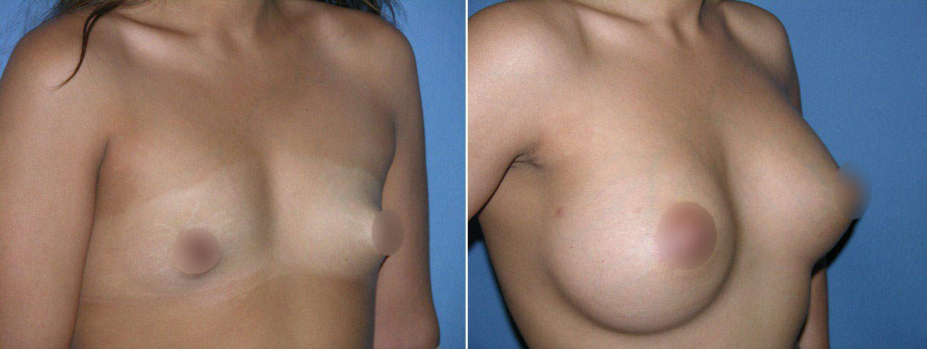 Breast Lift Procedure Before & After San Diego