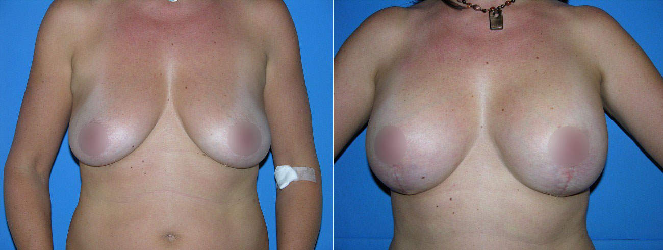 Breast Lift Before & After San Diego CA
