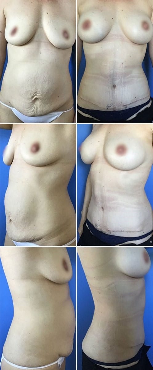 Patient 1482 Tummy Tuck, Breast Reduction, Mommy Makeover Before