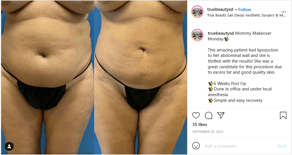 Tummy Tuck Recovery Timeline