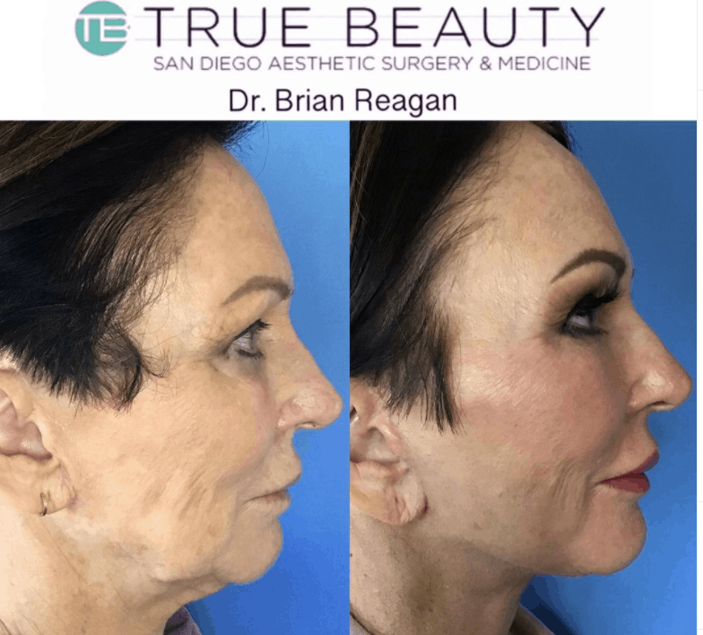 Facelift Before and After Photos