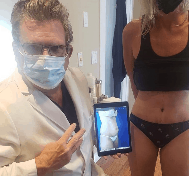 Tummy Tuck Patient Before and After Photos in La Jolla