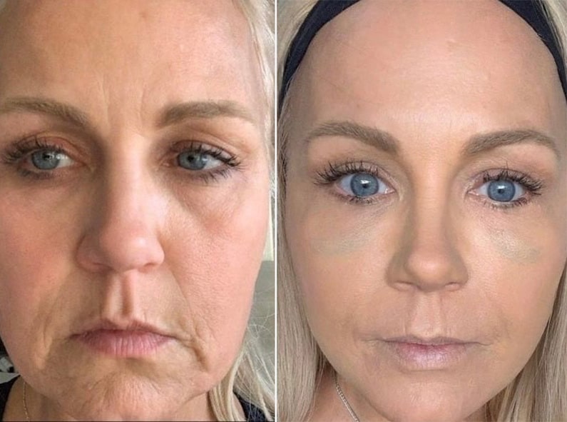Facial Rejuvenation Treatment Before & After San Diego & La Jolla CA