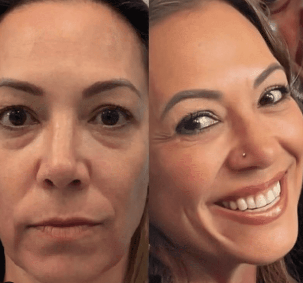 Blepharoplasty San Diego, CA