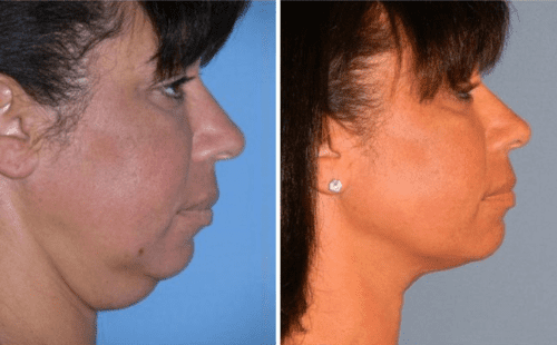 Buccal Fat Pad Removal Before and After Photo Gallery, San Diego, CA