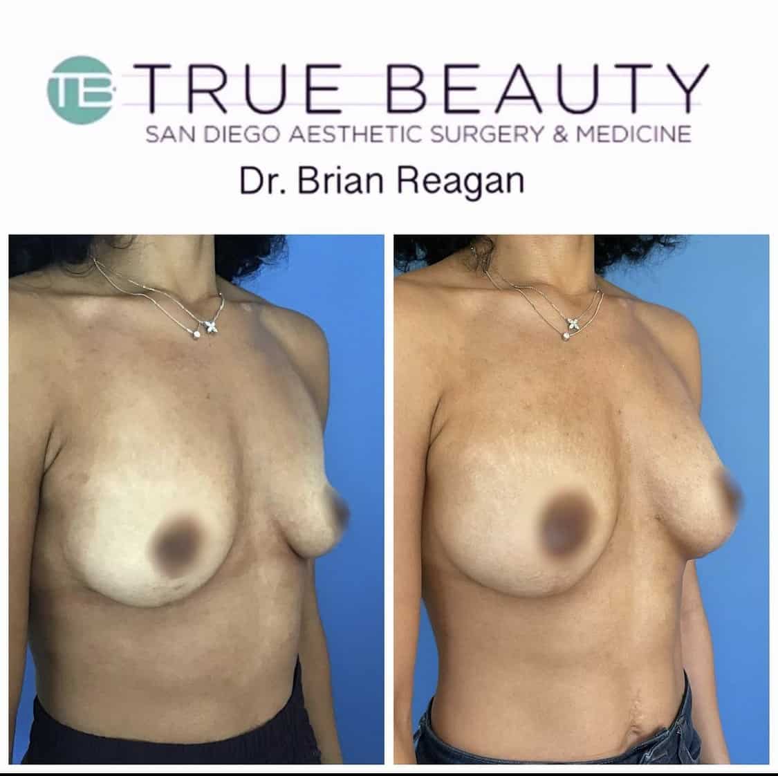 Breast Augmentation San Diego, CA
