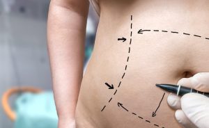 Drainless Tummy Tuck San Diego CA