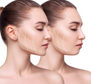 Facial Liposuction La Jolla CA