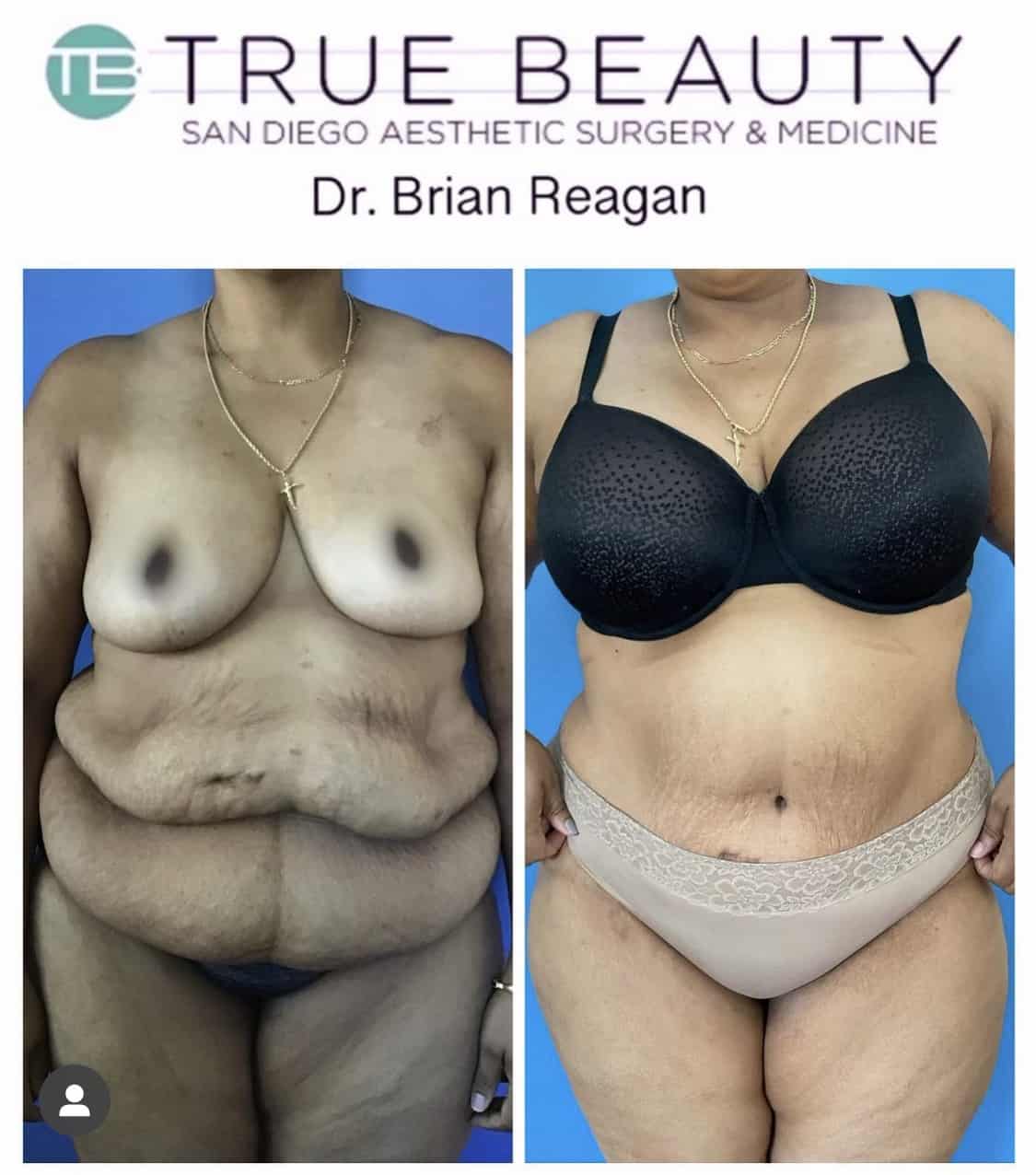 Tummy Tuck Recovery