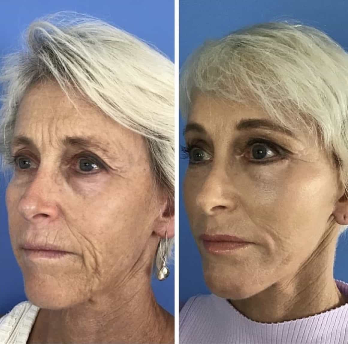 Facial Fat Grafting San Diego