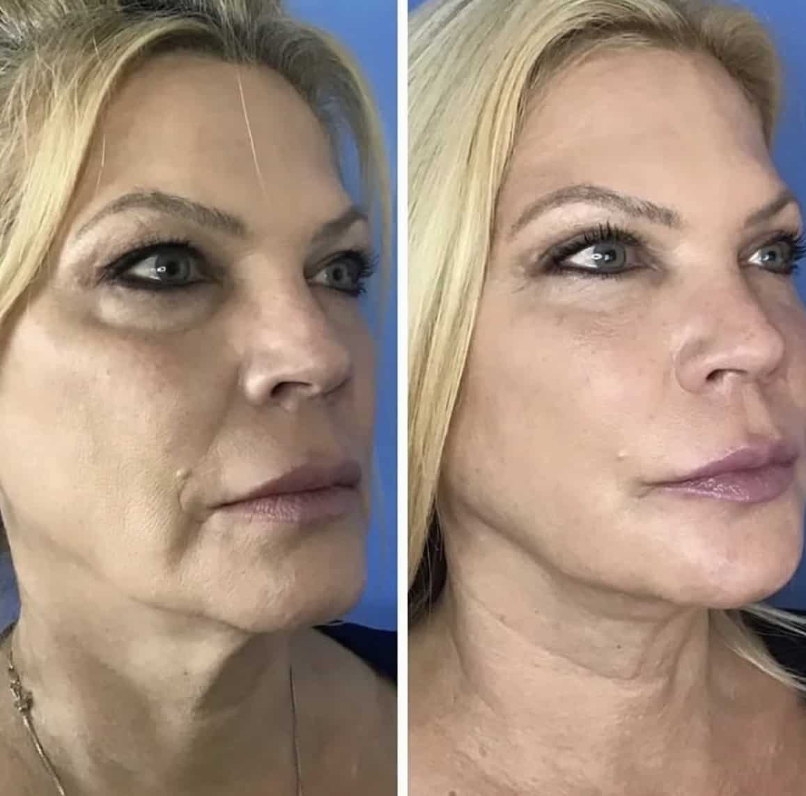 AccuTite Treatment San Diego