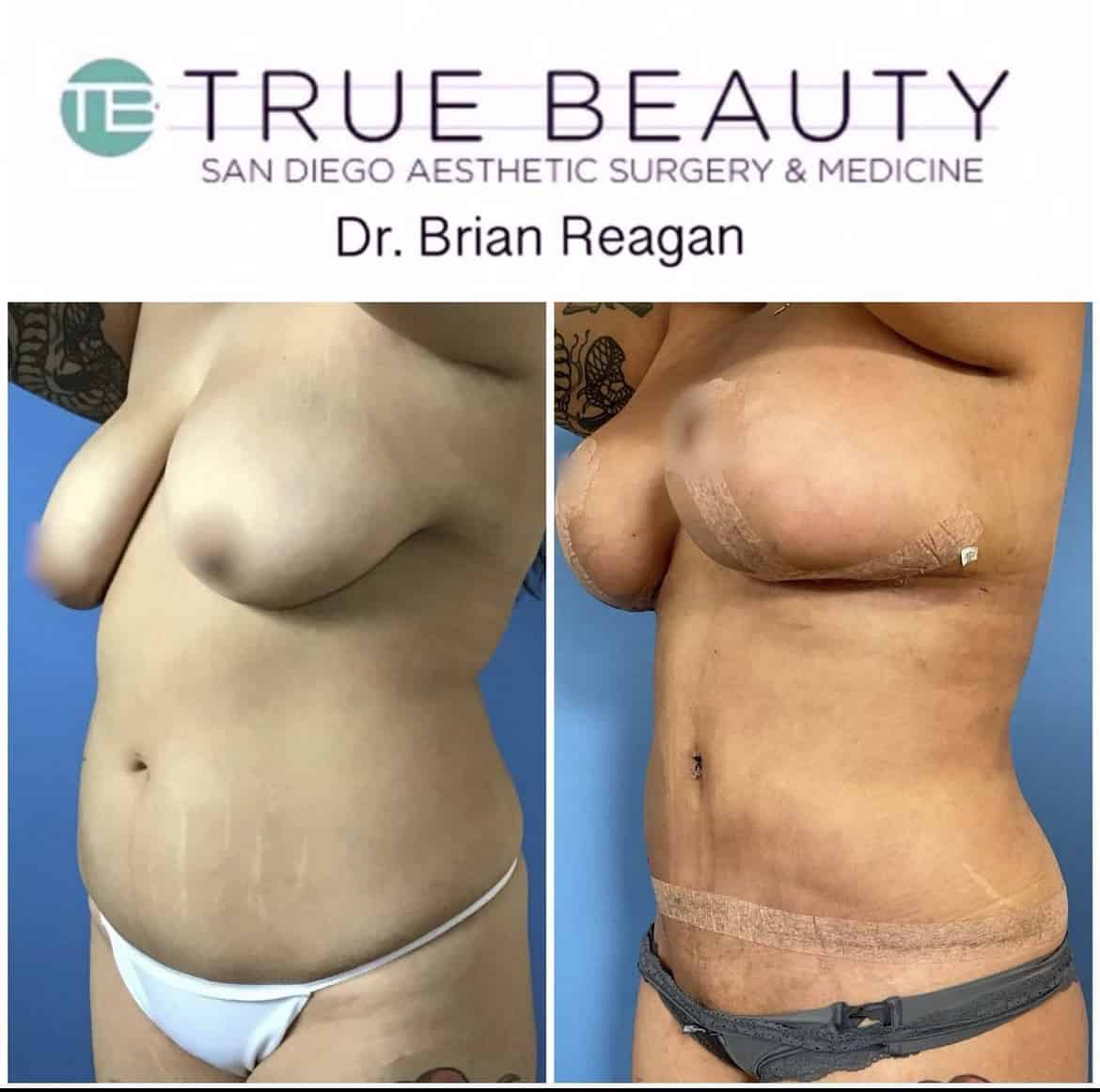 Drainless Tummy Tuck San Diego