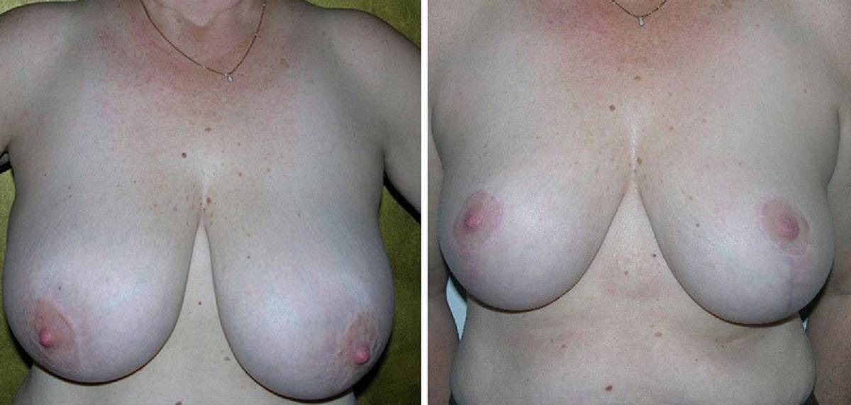 Breast Reduction Surgery La Jolla
