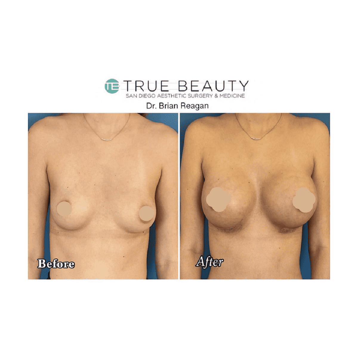 Breast lift La Jolla