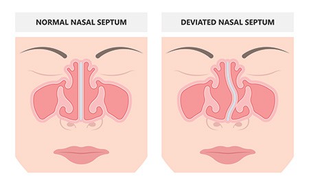 Functional Rhinoplasty  La Jolla 