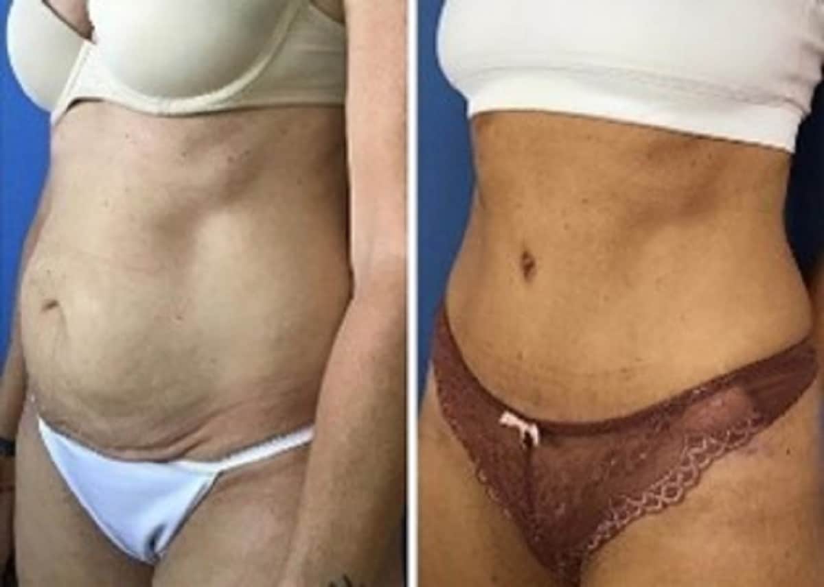 Tummy Tuck 360 results in La Jolla