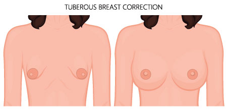 breast surgeon for tuberous breasts in La Jolla 